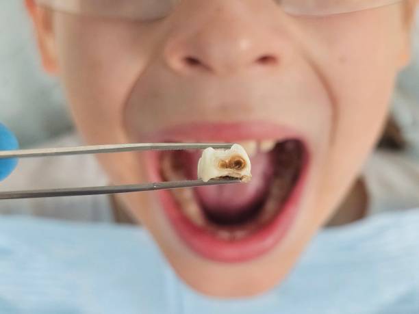 Best Emergency Treatment for Dental Infections or Abscesses in Lyndon, KY